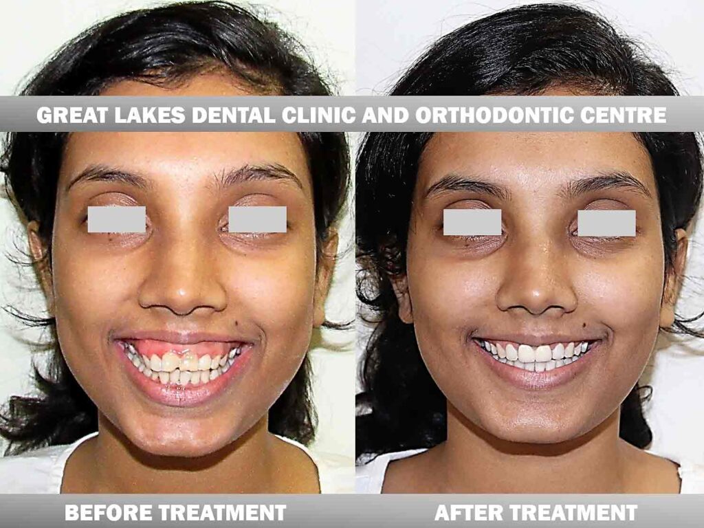 TREATMENT RESULTS Great Lakes Dental Clinic and Orthodontic Centre