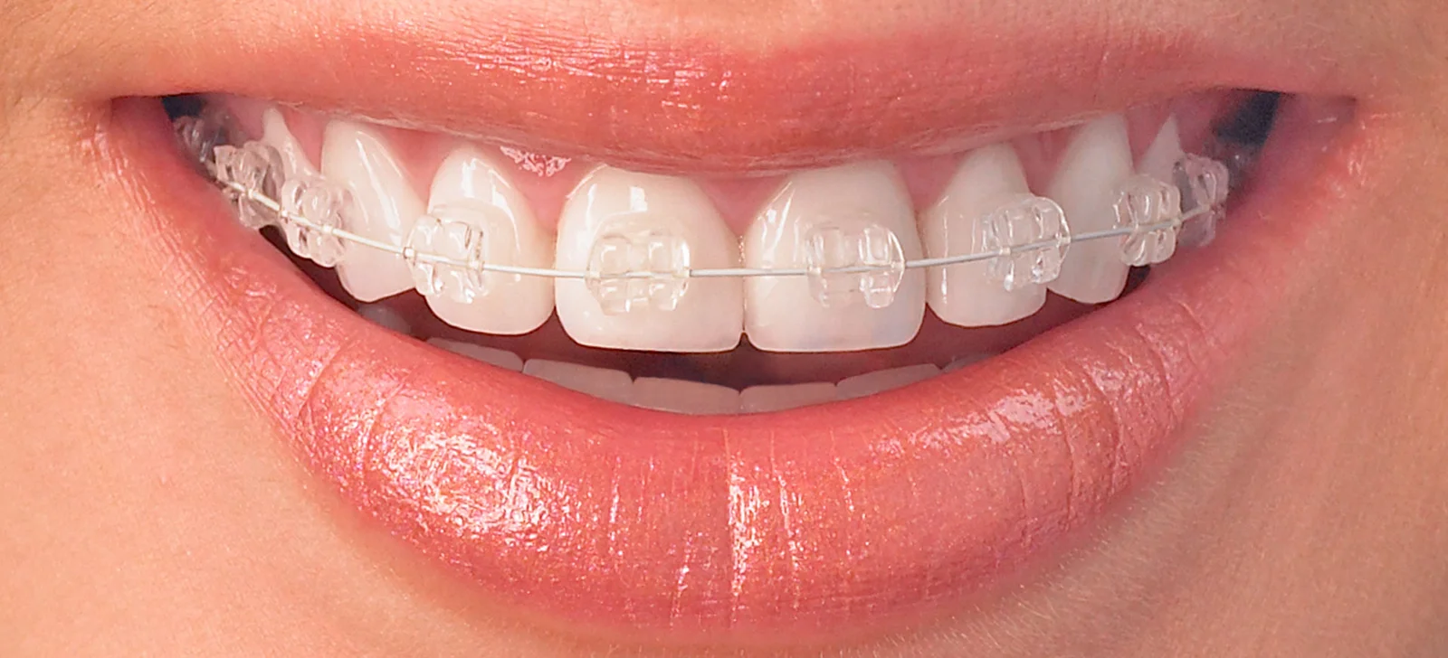Dental Braces 2 Clear ceramic Braces Clear ceramic Braces