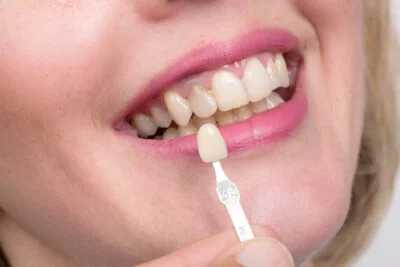 Dental crown veneer