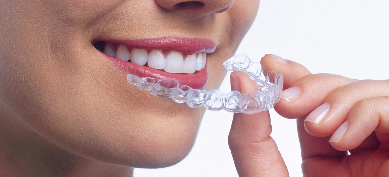 Dental Braces 3 Invisalign Invisalign