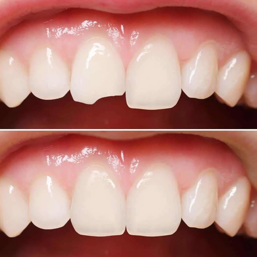 composite bonding