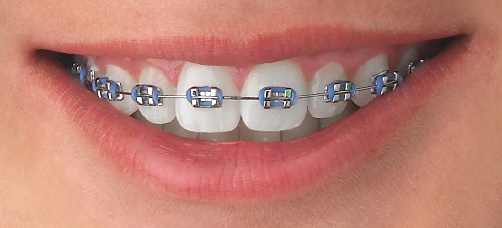 orthodontics tre