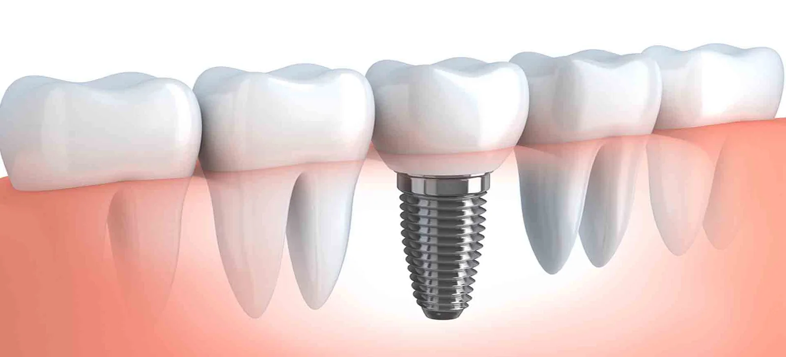 periodontics implantation tre